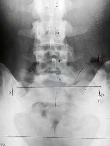 Chiropractic Grand Rapids MI Spondylolisthesis xray Chiropractic Grand Rapids MI Spondylolisthesis xray
