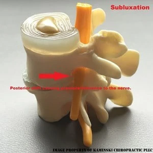 Chiropractic Grand Rapids MI Subluxation Vertebrae