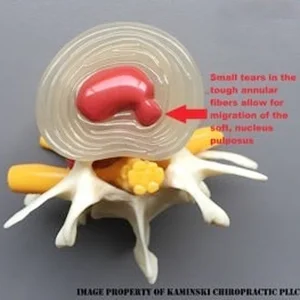 Chiropractic Grand Rapids MI Mild Disc Herniation Diagram showing small tears in spinal disc fibers with slight nucleus pulposus migration.
