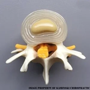 Intervertebral Disc Issues in Grand Rapids MI Intervertebral Disc Issues in Grand Rapids MI