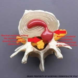 Chiropractic Grand Rapids MI Severe Disc Herniation Diagram showing significant disc damage with nucleus material pressing on nerve pathways.