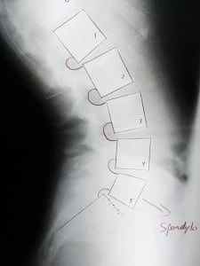 Chiropractic Grand Rapids MI Spondylolisthesis XRay 2 X-ray image showing spinal misalignment across five labeled vertebrae.
