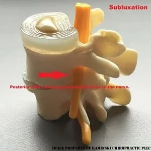 Chiropractic Grand Rapids MI Subluxation Vertebrae Model of a subluxated vertebra, with an arrow indicating nerve compression due to a posterior disc bulge.