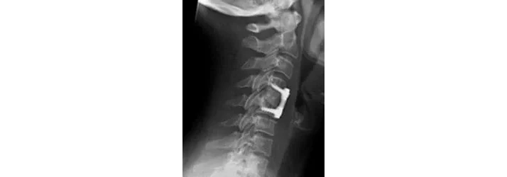“I’ve had Surgery, I can’t get Chiropractic Care in Grand Rapids MI.” FALSE “I’ve had Surgery, I can’t get Chiropractic Care in Grand Rapids MI.” FALSE