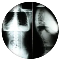 Front and side views of spinal X-rays used for diagnostic purposes.